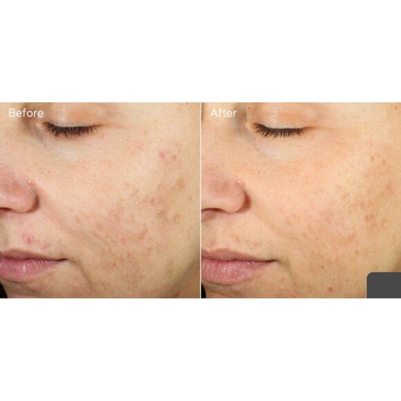 Murad InvisiScar Resurfacing Treatment FULL SIZE - Picture 11 of 12